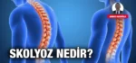 SKOLYOZ-NEDIR-KRITER-HABER