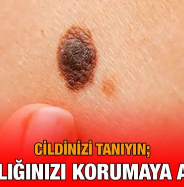 cilt_kanseri_kriter_haber