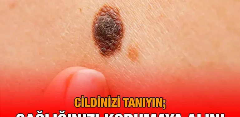 cilt_kanseri_kriter_haber