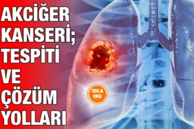 akciger_kanseri_ayi_kriter_haber