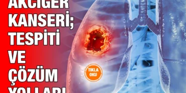 akciger_kanseri_ayi_kriter_haber