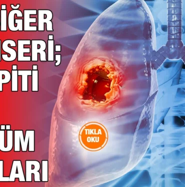 akciger_kanseri_ayi_kriter_haber