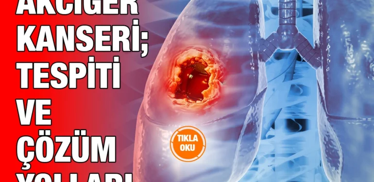 akciger_kanseri_ayi_kriter_haber
