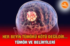 beyin_tumoru_kriter-haber