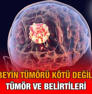 beyin_tumoru_kriter-haber