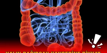 kalin_kanseri_kriter_haber