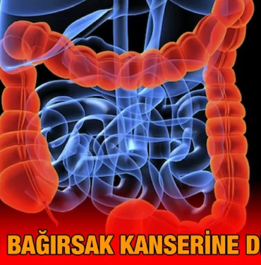 kalin_kanseri_kriter_haber