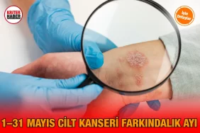cilt_kanseri_ayi_kriter_haber