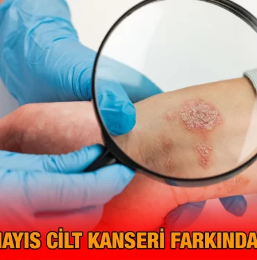 cilt_kanseri_ayi_kriter_haber