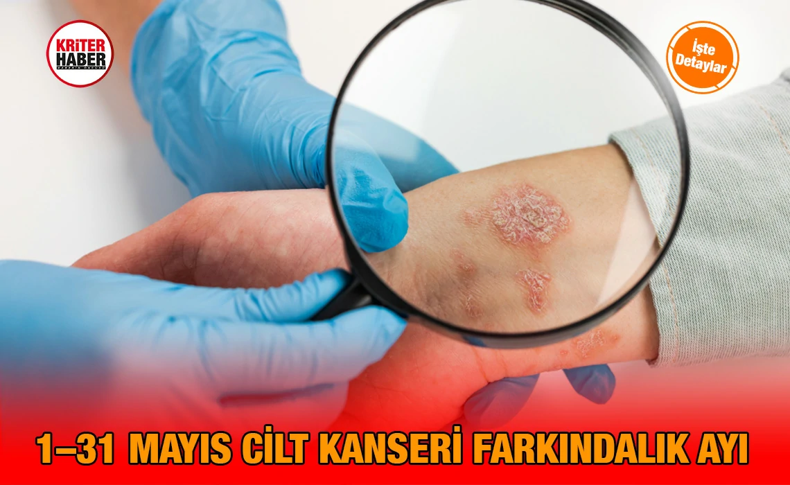 cilt_kanseri_ayi_kriter_haber